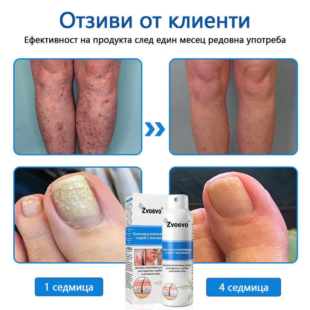 Официален магазин✅: Zvoevo® Магнезиев билков спрей за псориазис⚕️Сертифициран от FDA (облекчаване на псориазис и екзема, подобряване на бактериални инфекции в гениталната област и лечение на акне и тъмни петна)📦