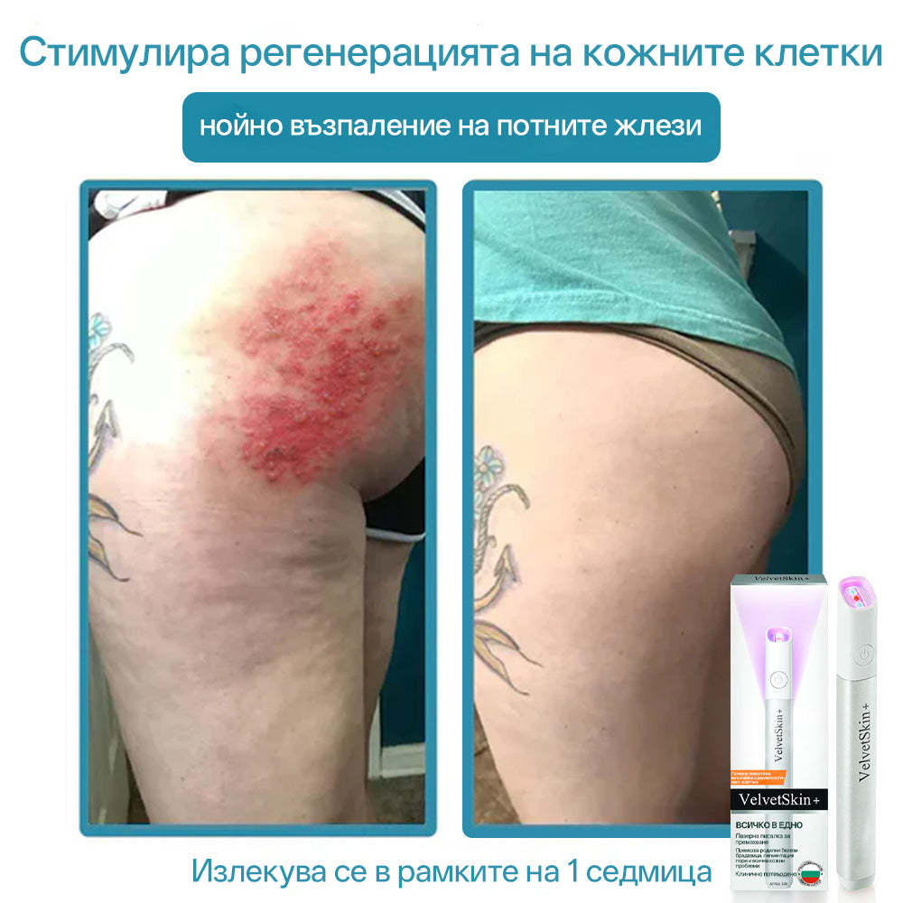 CO₂ лазерна писалка за премахване на 🟤 родилни белези, 🦠 брадавици, 🔘 петна и други кожни несъвършенства
