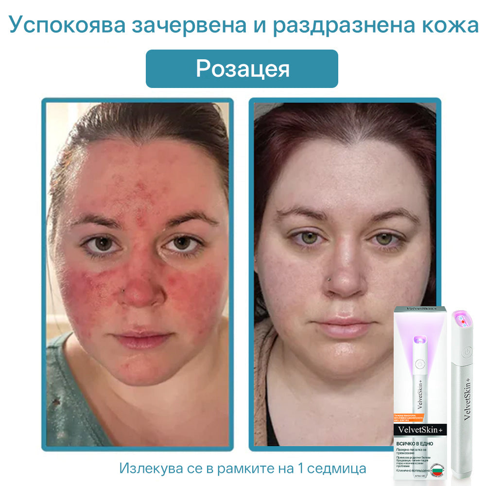CO₂ лазерна писалка за премахване на 🟤 родилни белези, 🦠 брадавици, 🔘 петна и други кожни несъвършенства