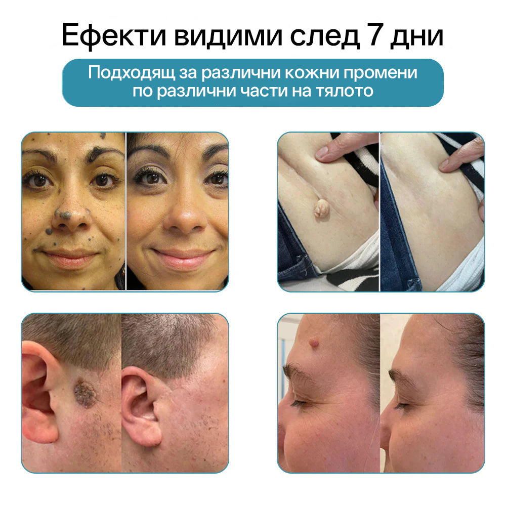 CO₂ лазерна писалка за премахване на 🟤 родилни белези, 🦠 брадавици, 🔘 петна и други кожни несъвършенства