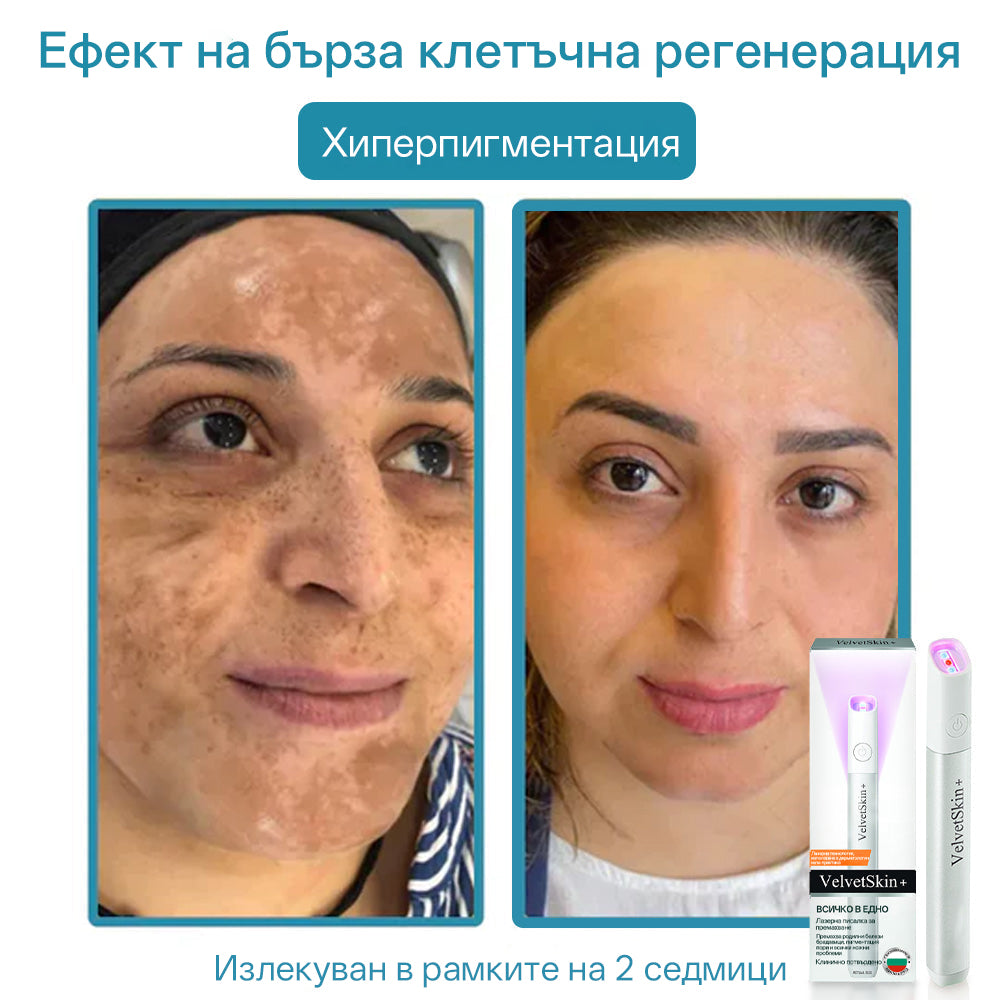 CO₂ лазерна писалка за премахване на 🟤 родилни белези, 🦠 брадавици, 🔘 петна и други кожни несъвършенства
