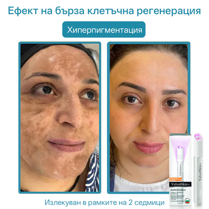 CO₂ лазерна писалка за премахване на 🟤 родилни белези, 🦠 брадавици, 🔘 петна и други кожни несъвършенства