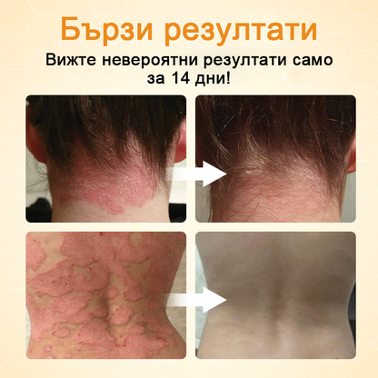 Timilk® BeeLieve Грижа за кожата при псориазис🎁