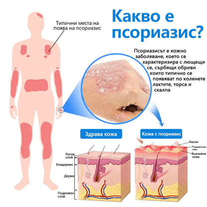 Официален магазин✅: Zvoevo® Магнезиев билков спрей за псориазис⚕️Сертифициран от FDA (облекчаване на псориазис и екзема, подобряване на бактериални инфекции в гениталната област и лечение на акне и тъмни петна)📦