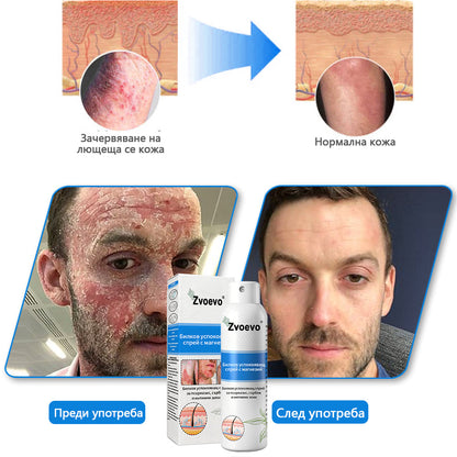 Официален магазин✅: Zvoevo® Магнезиев билков спрей за псориазис⚕️Сертифициран от FDA (облекчаване на псориазис и екзема, подобряване на бактериални инфекции в гениталната област и лечение на акне и тъмни петна)📦