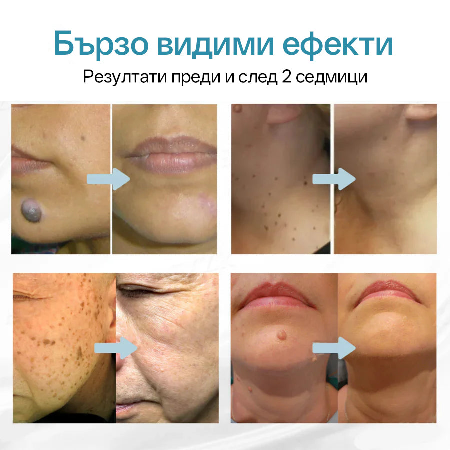 CO₂ лазерна писалка за премахване на 🟤 родилни белези, 🦠 брадавици, 🔘 петна и други кожни несъвършенства