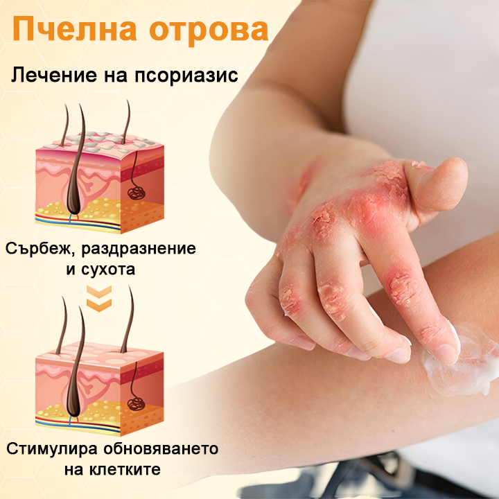 Timilk® BeeLieve Грижа за кожата при псориазис🎁