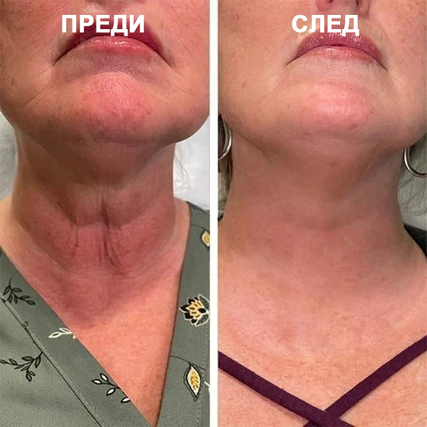💝Последен ден на промоцията 60% отстъпка - Fubsta™ Укрепващ серум за подмладяване на кожата🔥
