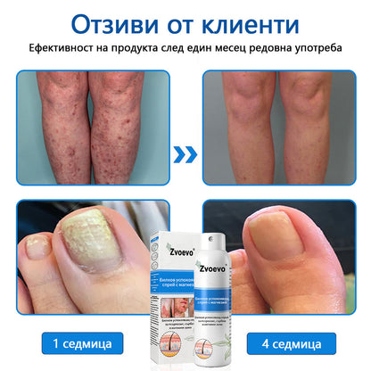 Официален магазин✅: Zvoevo® Магнезиев билков спрей за псориазис⚕️Сертифициран от FDA (облекчаване на псориазис и екзема, подобряване на бактериални инфекции в гениталната област и лечение на акне и тъмни петна)📦