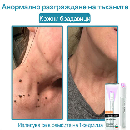 CO₂ лазерна писалка за премахване на 🟤 родилни белези, 🦠 брадавици, 🔘 петна и други кожни несъвършенства